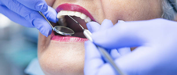 Best Emergency Dental Extractions in Seal Beach, CA