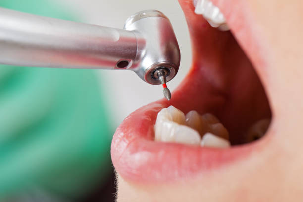 Best Broken or Cracked Tooth Emergency Dentist in Seal Beach, CA